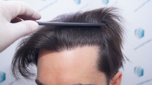 Injerto Capilar Técnica FUE 1916 Grafts (4597 Pelos) 43 RESULTADOS INJERTO CAPILAR EN 12 MESES
