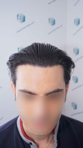 Injerto Capilar Técnica FUE 1916 Grafts (4597 Pelos) 44 RESULTADOS INJERTO CAPILAR EN 12 MESES