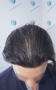Injerto Capilar Técnica FUE 1916 Grafts (4597 Pelos) 45 RESULTADOS INJERTO CAPILAR EN 12 MESES