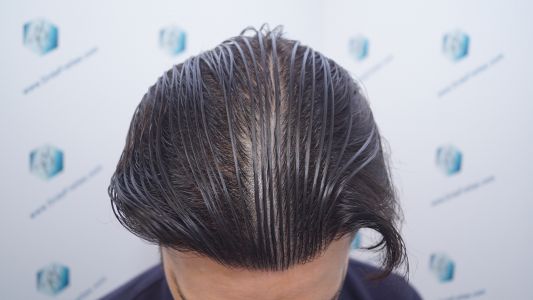 Injerto Capilar Técnica FUE 1916 Grafts (4597 Pelos) 46 RESULTADOS INJERTO CAPILAR EN 12 MESES