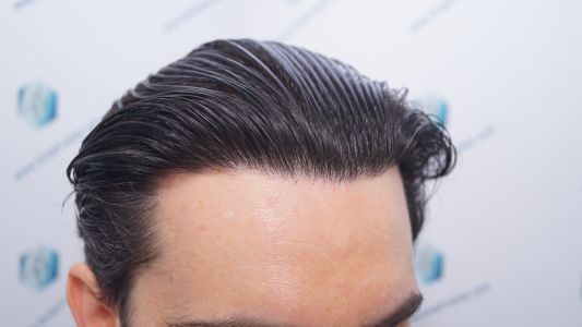 Injerto Capilar Técnica FUE 1916 Grafts (4597 Pelos) 47 RESULTADOS INJERTO CAPILAR EN 12 MESES