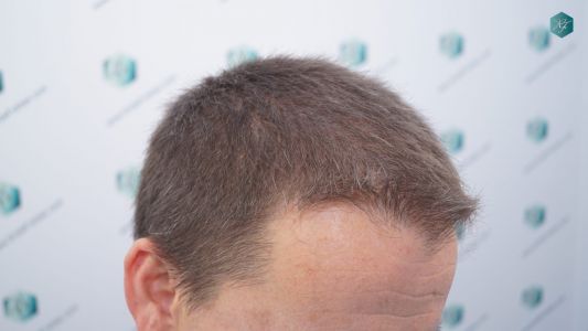 Injerto Capilar Técnica FUE 2759 Grafts (6049 Pelos) 4 Injerto Capilar Técnica FUE 2759 Grafts (6049 Pelos)