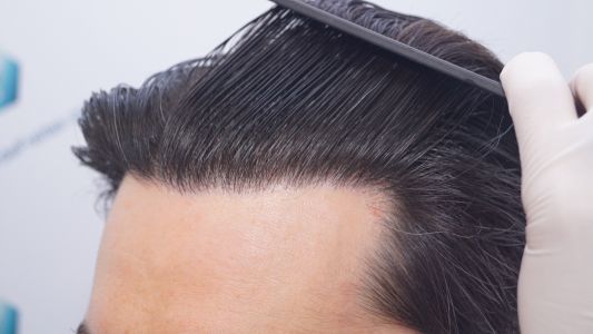 Injerto Capilar Técnica FUE 1916 Grafts (4597 Pelos) 51 RESULTADOS INJERTO CAPILAR EN 12 MESES