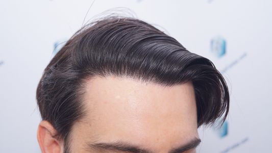 Injerto Capilar Técnica FUE 1916 Grafts (4597 Pelos) 52 RESULTADOS INJERTO CAPILAR EN 12 MESES