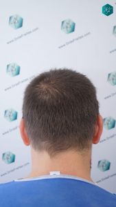 Injerto Capilar Técnica FUE 2759 Grafts (6049 Pelos) 5 Injerto Capilar Técnica FUE 2759 Grafts (6049 Pelos)