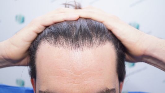 Injerto Capilar Técnica FUE 1916 Grafts (4597 Pelos) 3 ANTES DEL TRASPLANTE CAPILAR