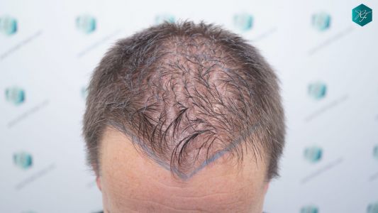 Injerto Capilar Técnica FUE 2759 Grafts (6049 Pelos) 6 Injerto Capilar Técnica FUE 2759 Grafts (6049 Pelos)