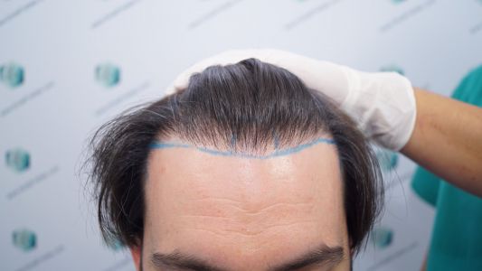 Injerto Capilar Técnica FUE 1916 Grafts (4597 Pelos) 10 DISEÑO LÍNEA INJERTO CAPILAR