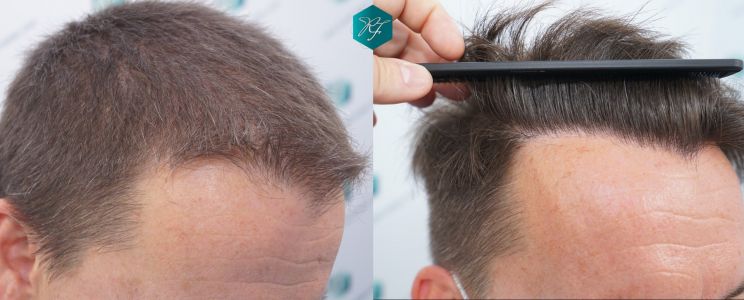 Injerto Capilar Técnica FUE 2759 Grafts (6049 Pelos) 41 COMPARATIVA INJERTO CAPILAR ANTES Y DESPUÉS