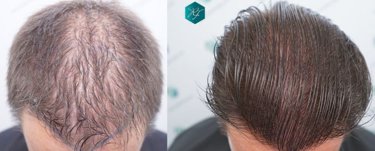 Injerto Capilar Técnica FUE 2759 Grafts (6049 Pelos) 38 COMPARATIVA INJERTO CAPILAR ANTES Y DESPUÉS
