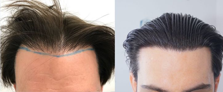 Injerto Capilar Técnica FUE 1916 Grafts (4597 Pelos) 56 COMPARATIVA INJERTO CAPILAR ANTES Y DESPUES