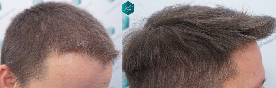 Injerto Capilar Técnica FUE 2759 Grafts (6049 Pelos) 39 COMPARATIVA INJERTO CAPILAR ANTES Y DESPUÉS
