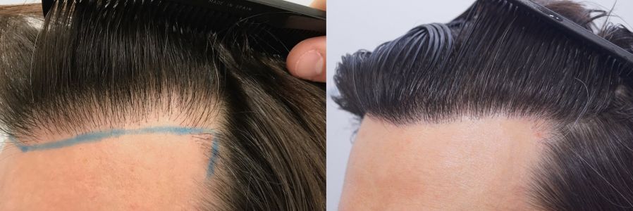 Injerto Capilar Técnica FUE 1916 Grafts (4597 Pelos) 58 COMPARATIVA INJERTO CAPILAR ANTES Y DESPUES