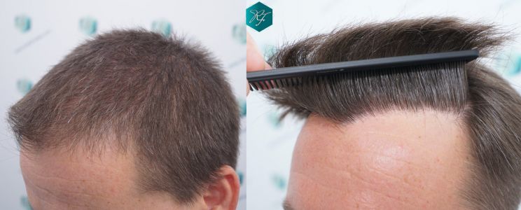Injerto Capilar Técnica FUE 2759 Grafts (6049 Pelos) 42 COMPARATIVA INJERTO CAPILAR ANTES Y DESPUÉS