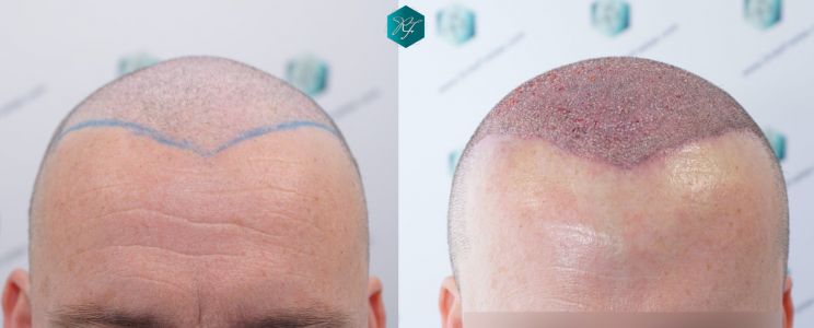 Injerto Capilar Técnica FUE 2759 Grafts (6049 Pelos) 43 COMPARATIVA INJERTO CAPILAR ANTES Y DESPUÉS