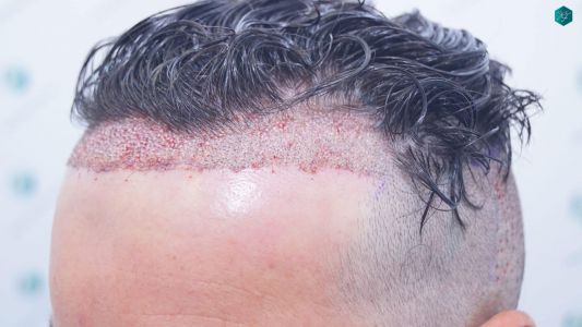 Injerto Capilar Técnica FUE 1873 Grafts (4766 Pelos) 8 10 TRASPLANTE INJERTO CAPILAR