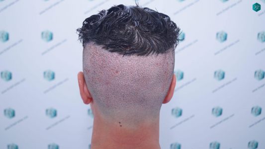 Injerto Capilar Técnica FUE 1873 Grafts (4766 Pelos) 9 11 TRASPLANTE INJERTO CAPILAR