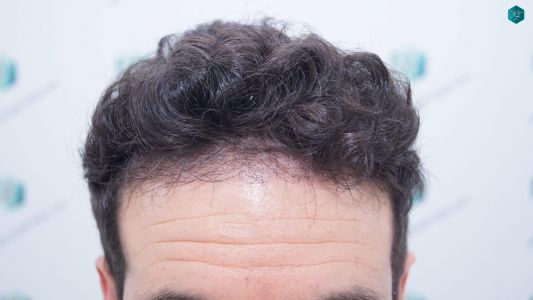 RESULTADOS INJERTO CAPILAR EN 3 MESES 12 RESULTADOS INJERTO CAPILAR EN 3 MESES