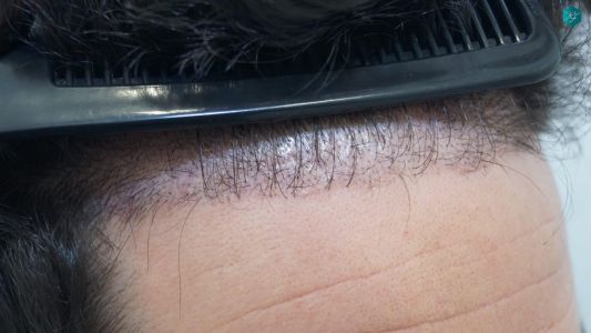 Injerto Capilar Técnica FUE 1873 Grafts (4766 Pelos) 10 13 RESULTADOS INJERTO CAPILAR EN 3 MESES