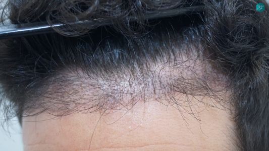 Injerto Capilar Técnica FUE 1873 Grafts (4766 Pelos) 11 14 RESULTADOS INJERTO CAPILAR EN 3 MESES
