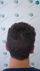 Injerto Capilar Técnica FUE 1873 Grafts (4766 Pelos) 12 15 RESULTADOS INJERTO CAPILAR EN 3 MESES