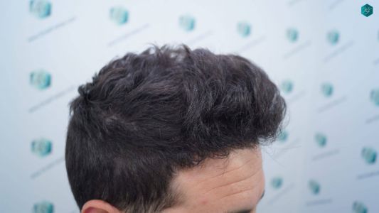Injerto Capilar Técnica FUE 1873 Grafts (4766 Pelos) 13 17 RESULTADOS INJERTO CAPILAR EN 12 MESES