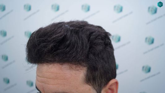 Injerto Capilar Técnica FUE 1873 Grafts (4766 Pelos) 14 18 RESULTADOS INJERTO CAPILAR EN 12 MESES