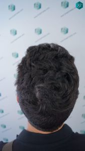 Injerto Capilar Técnica FUE 1873 Grafts (4766 Pelos) 15 19 RESULTADOS INJERTO CAPILAR EN 12 MESES