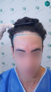 Injerto Capilar Técnica FUE 1873 Grafts (4766 Pelos) 1 2 DISEÑO LINEA INJERTO