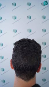 Injerto Capilar Técnica FUE 1873 Grafts (4766 Pelos) 16 20 RESULTADOS INJERTO CAPILAR EN 12 MESES