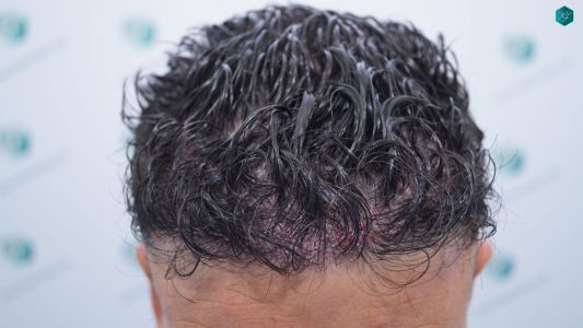 Injerto Capilar Técnica FUE 1873 Grafts (4766 Pelos) 17 22 RETOQUE INJERTO CAPILAR