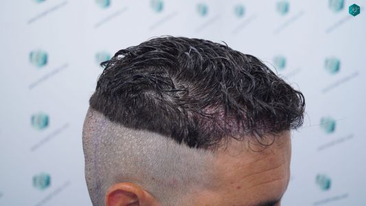 Injerto Capilar Técnica FUE 1873 Grafts (4766 Pelos) 18 23 RETOQUE INJERTO CAPILAR