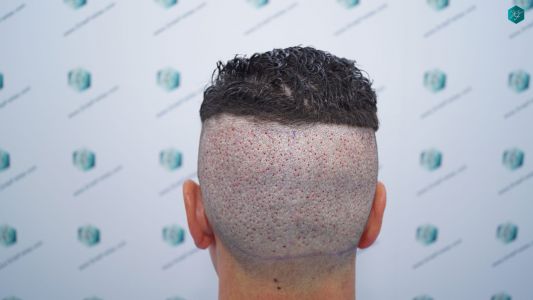 Injerto Capilar Técnica FUE 1873 Grafts (4766 Pelos) 20 25 RETOQUE INJERTO CAPILAR