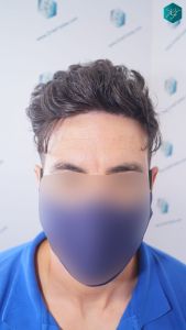 RESULTADOS RETOQUE INJERTO CAPILAR EN 12 MESES 26 RESULTADOS INJERTO CAPILAR EN 12 MESES RETOQUE