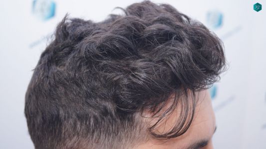 Injerto Capilar Técnica FUE 1873 Grafts (4766 Pelos) 21 27 RESULTADOS INJERTO CAPILAR EN 12 MESES RETOQUE
