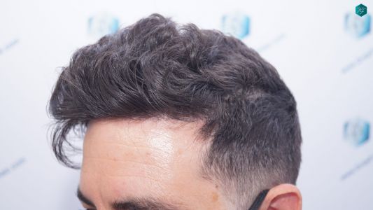 Injerto Capilar Técnica FUE 1873 Grafts (4766 Pelos) 22 28 RESULTADOS INJERTO CAPILAR EN 12 MESES RETOQUE