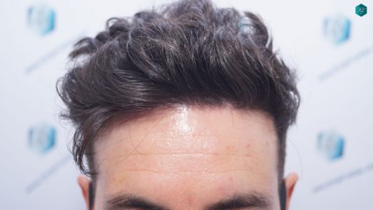 Injerto Capilar Técnica FUE 1873 Grafts (4766 Pelos) 23 29 RESULTADOS INJERTO CAPILAR EN 12 MESES RETOQUE