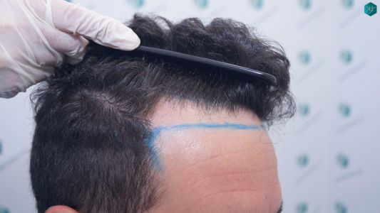 Injerto Capilar Técnica FUE 1873 Grafts (4766 Pelos) 2 3 DISEÑO LINEA INJERTO