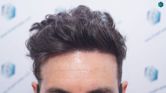 Injerto Capilar Técnica FUE 1873 Grafts (4766 Pelos) 24 30 RESULTADOS INJERTO CAPILAR EN 12 MESES RETOQUE