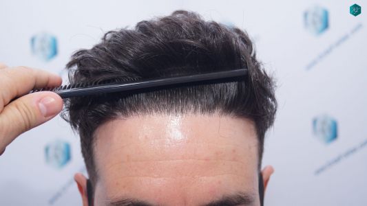 Injerto Capilar Técnica FUE 1873 Grafts (4766 Pelos) 25 31 RESULTADOS INJERTO CAPILAR EN 12 MESES RETOQUE