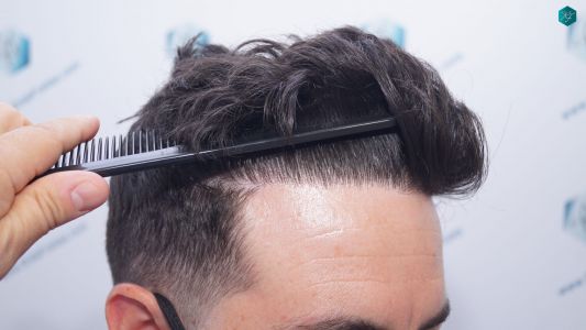 Injerto Capilar Técnica FUE 1873 Grafts (4766 Pelos) 26 32 RESULTADOS INJERTO CAPILAR EN 12 MESES RETOQUE