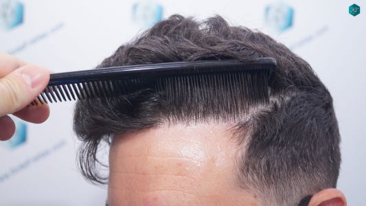 Injerto Capilar Técnica FUE 1873 Grafts (4766 Pelos) 28 34 RESULTADOS INJERTO CAPILAR EN 12 MESES RETOQUE