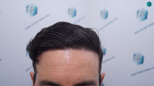 Injerto Capilar Técnica FUE 1873 Grafts (4766 Pelos) 29 35 RESULTADOS INJERTO CAPILAR EN 12 MESES RETOQUE