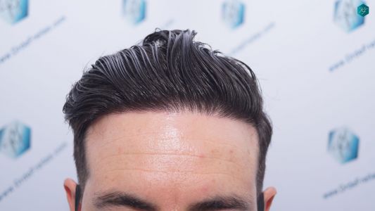 Injerto Capilar Técnica FUE 1873 Grafts (4766 Pelos) 30 36 RESULTADOS INJERTO CAPILAR EN 12 MESES RETOQUE