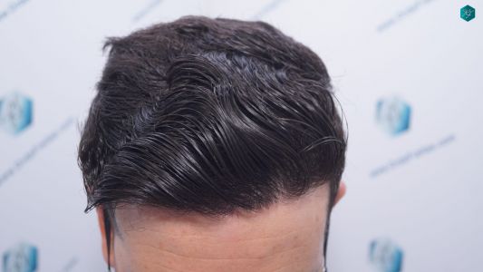Injerto Capilar Técnica FUE 1873 Grafts (4766 Pelos) 31 RESULTADOS INJERTO CAPILAR EN 12 MESES RETOQUE