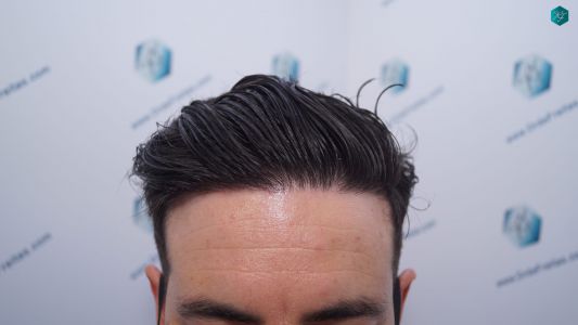 Injerto Capilar Técnica FUE 1873 Grafts (4766 Pelos) 32 RESULTADOS INJERTO CAPILAR EN 12 MESES RETOQUE