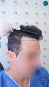 Injerto Capilar Técnica FUE 1873 Grafts (4766 Pelos) 3 4 DISEÑO LINEA INJERTO