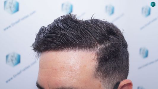 Injerto Capilar Técnica FUE 1873 Grafts (4766 Pelos) 35 RESULTADOS INJERTO CAPILAR EN 12 MESES RETOQUE