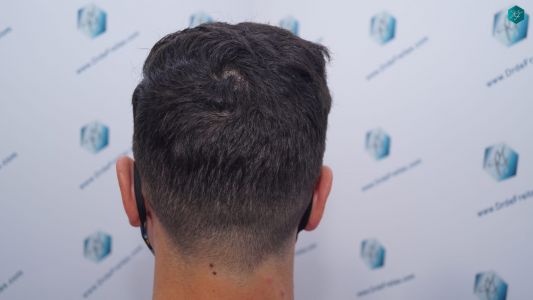 Injerto Capilar Técnica FUE 1873 Grafts (4766 Pelos) 36 RESULTADOS INJERTO CAPILAR EN 12 MESES RETOQUE