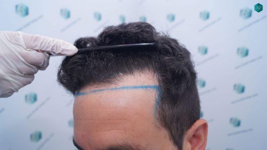 Injerto Capilar Técnica FUE 1873 Grafts (4766 Pelos) 4 5 DISEÑO LINEA INJERTO
